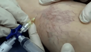 szkleroterápia visszér kezelésére