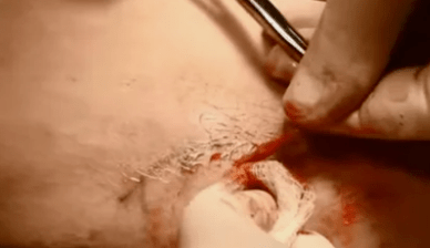 típusú műveletek a varikózus vénák eltávolítására